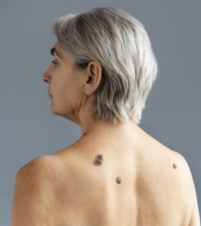 Что делать, если появилась неприятная родинка?